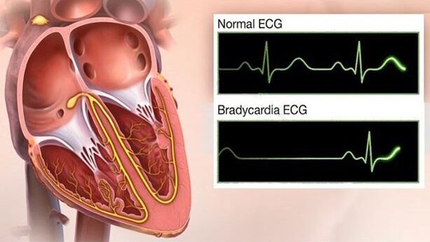 bradykardia w nadciśnieniu